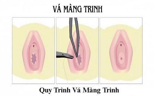 Vá màng trinh là gì giá vá màng trinh hết bao nhiêu tiền 1