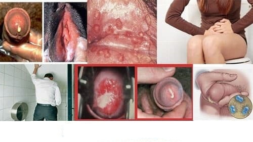 Mức độ và tình trạng bệnh lậu cần chữa