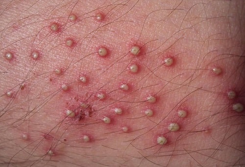 Dương vật nổi mụn đỏ trắng ngứa là bệnh gì