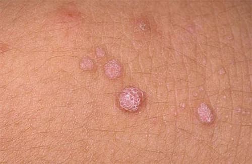 Dương vật nổi mụn đỏ trắng ngứa là bệnh gì 2