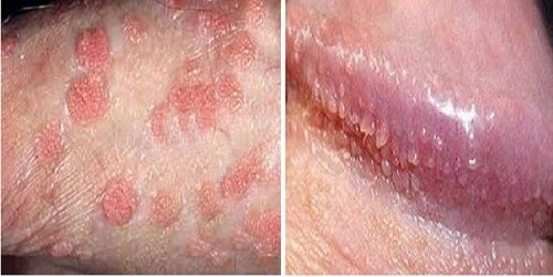 Dương vật nổi mụn đỏ trắng ngứa là bệnh gì 3