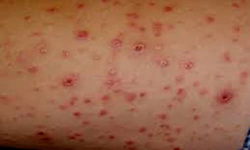 Dương vật nổi mụn đỏ trắng ngứa là bệnh gì 4