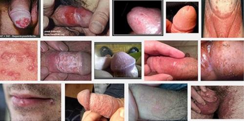 Dương vật nổi mụn đỏ trắng ngứa là bệnh gì 5