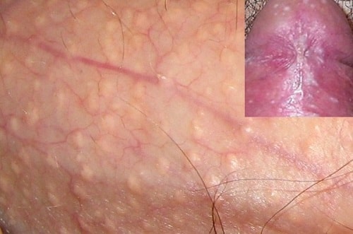Dương vật nổi mụn đỏ trắng ngứa là bệnh gì 7