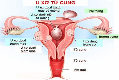 12 Cách chữa và làm giảm đau bụng kinh nhanh nhất cấp tốc 4