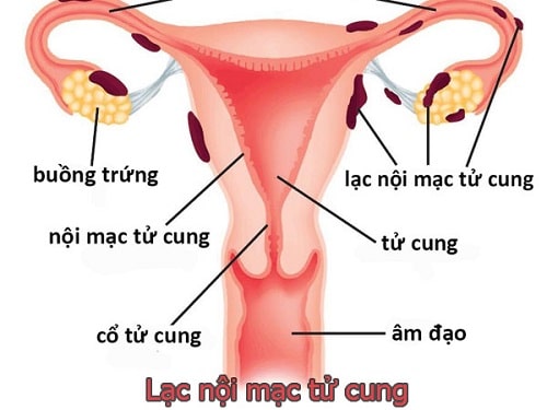 12 Cách chữa và làm giảm đau bụng kinh nhanh nhất cấp tốc 5