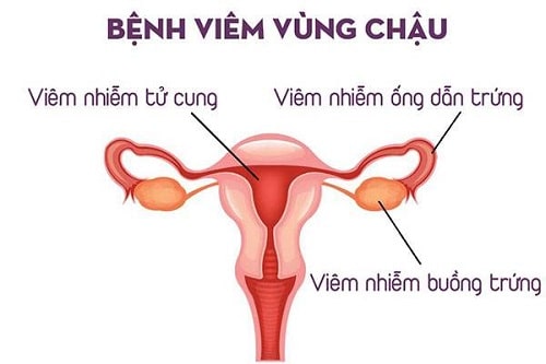 12 Cách chữa và làm giảm đau bụng kinh nhanh nhất cấp tốc 6
