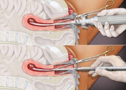 Phá thai 5 tuần tuổi có được không cách nào an toàn hiệu quả 6