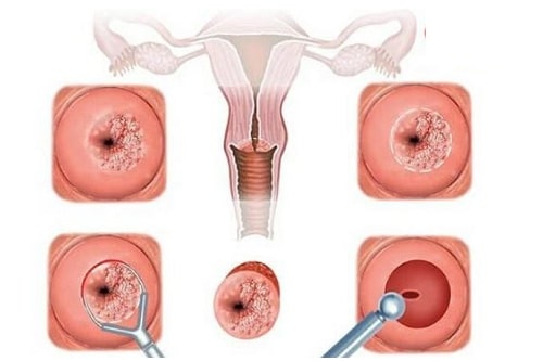 Top 6 địa chỉ đốt viêm lộ tuyến cổ tử cung ở đâu tốt nhất 6