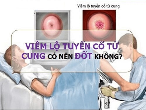 Chi phí đốt viêm lộ tuyến cổ tử cung bao nhiêu tiền - Bảng giá 2020