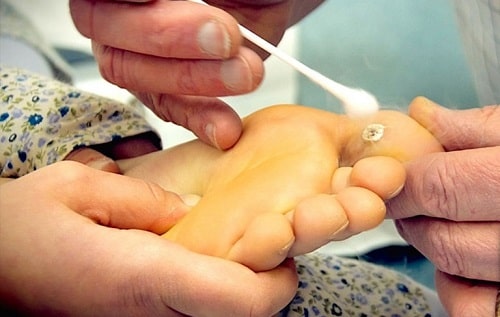 Mụn cóc là gì cách trị mụn cóc ở tay chân tại nhà nhanh khỏi nhất 10