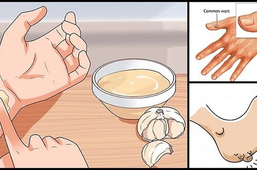 Mụn cóc là gì cách trị mụn cóc ở tay chân tại nhà nhanh khỏi nhất 12