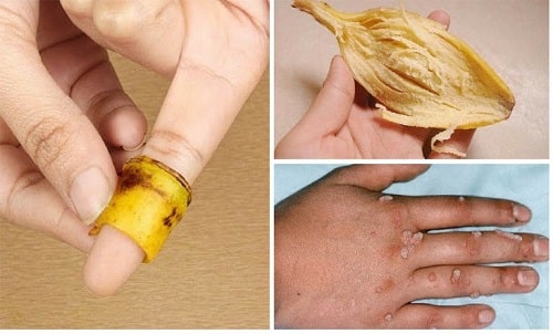 Mụn cóc là gì cách trị mụn cóc ở tay chân tại nhà nhanh khỏi nhất 13