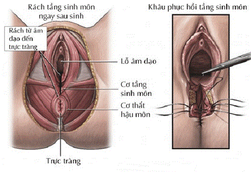 Kỹ thuật làm thon gọn âm đạo vùng kín nữ