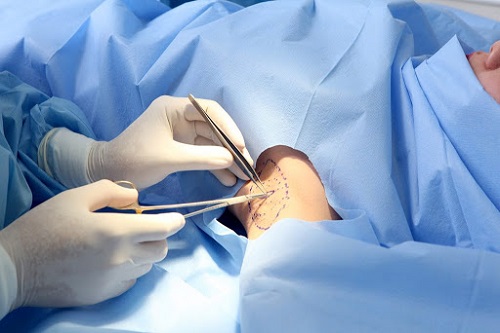 Cách chữa hôi nách an toàn triệt để hiệu quả vĩnh viễn 12