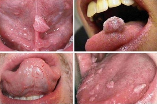 Sùi mào gà ở nữ giới vị trí nào có chữa được không 2