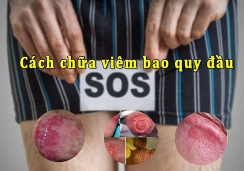 8 Cách chữa viêm bao quy đầu an toàn hiệu quả nhanh nhất hiện nay 2