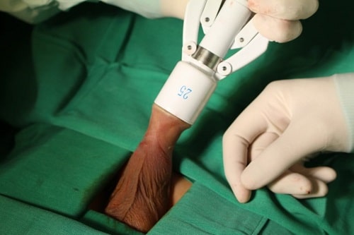 8 Cách chữa viêm bao quy đầu an toàn hiệu quả nhanh nhất hiện nay 3