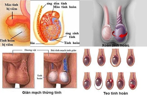 Đau tinh hoàn nguyên nhân là gì khám ở đâu tốt nhất 3