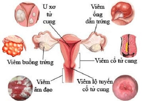 15 Cách chữa khí hư có mùi hôi ra nhiều có màu vàng xanh lạ 2
