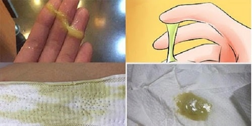 15 Cách chữa khí hư có mùi hôi ra nhiều có màu vàng xanh lạ 3