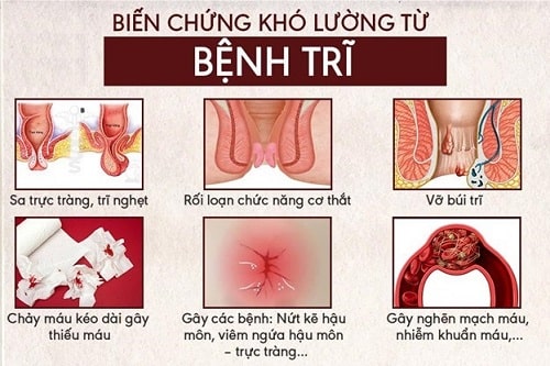 10 Cách chữa bệnh trĩ nội hiệu quả nhất điều trị trĩ nội nhanh chóng