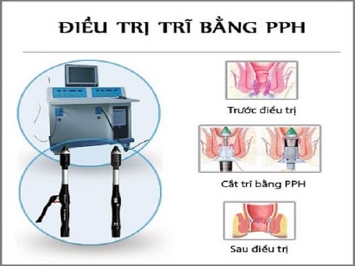 10 Cách chữa bệnh trĩ nội hiệu quả nhất điều trị trĩ nội nhanh chóng 5