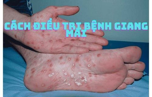 Giải pháp điều trị giang mai hiệu quả vĩnh viễn 1