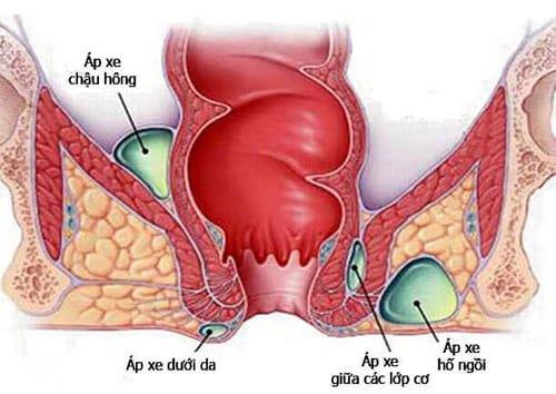 Áp xe hậu môn
