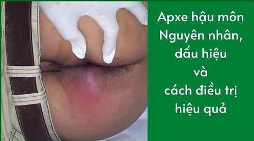 Áp xe hậu môn 2