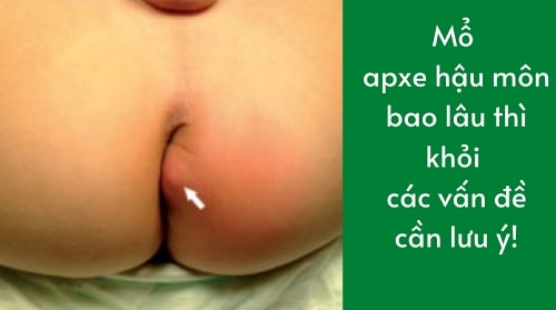 Áp xe hậu môn 4