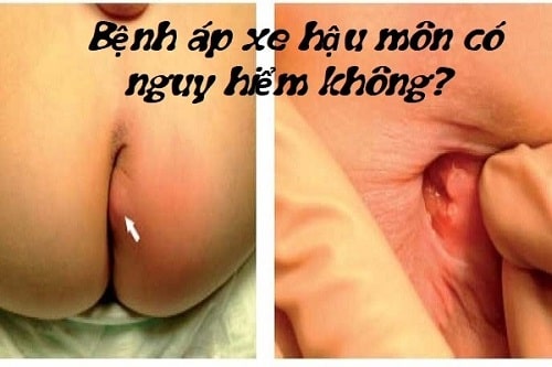 Áp xe hậu môn 3