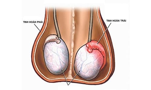 Nguyên nhân đau tinh hoàn trái và cách chữa trị