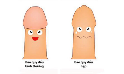 Hẹp bao quy đầu là gì?