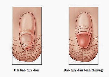 Hình ảnh dài bao quy đầu