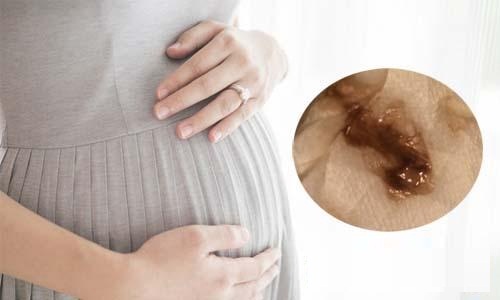 Mang thai ra dịch màu nâu nhạt nguy hiểm như thế nào?
