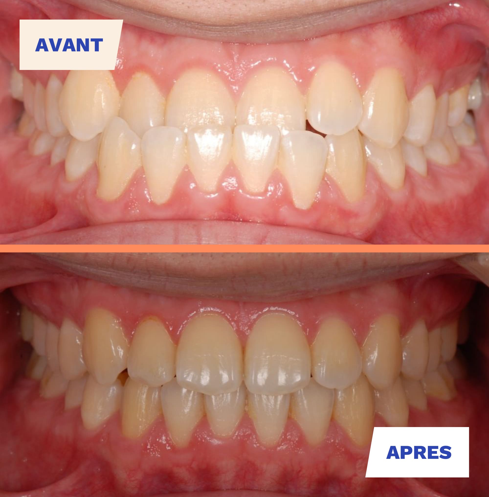 resultat du traitement invisalign avant et apres