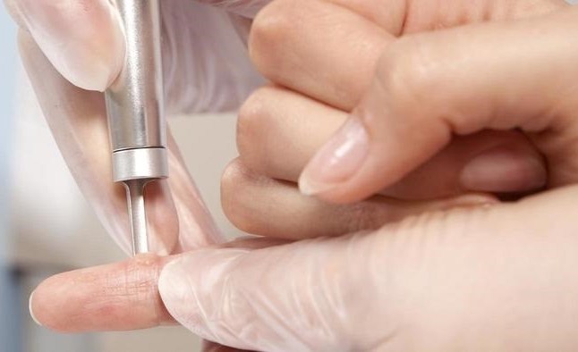 Nên đốt mụn cóc ở đâu?