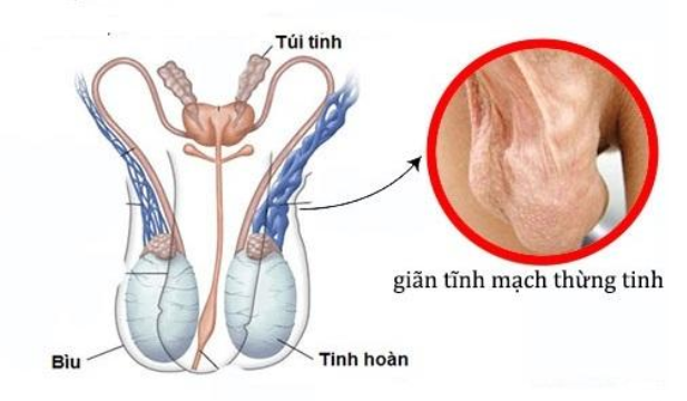 Giãn tĩnh mạch thừng tinh độ 3 như thế nào?