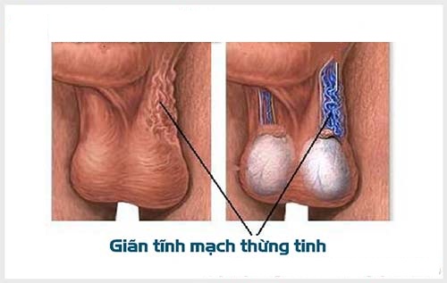 Giãn tĩnh mạch thừng tinh bệnh học