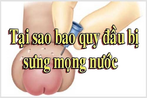 Nguyên nhân bao quy đầu bị sưng mọng nước cũng như cách phòng tránh