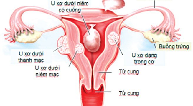 Bệnh u xơ tử cung có mang thai được không