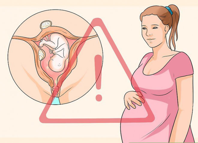mang thai bị u xơ tử cung nên kiêng những gì