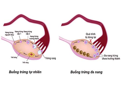 buồng trứng đa nang