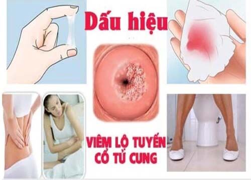 viêm lộ tuyến cổ tử cung độ 1