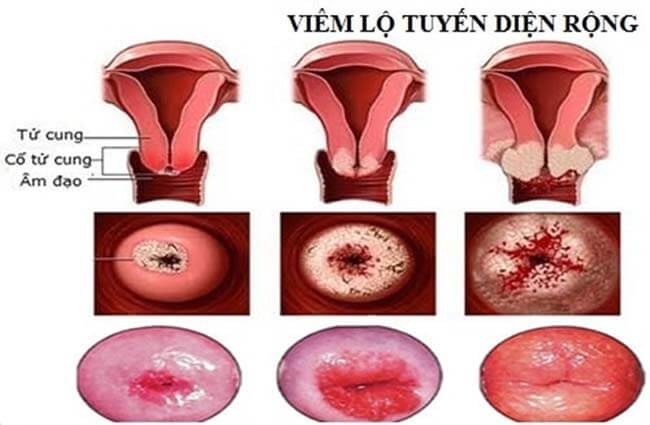 viêm lộ tuyến cổ tử cung là gì
