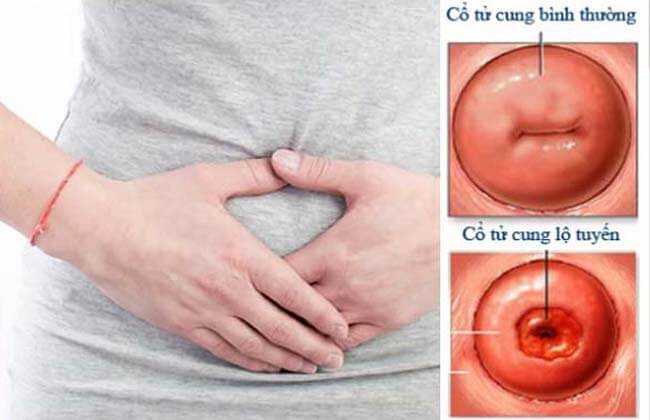 Chữa viêm lộ tuyến cổ tử cung
