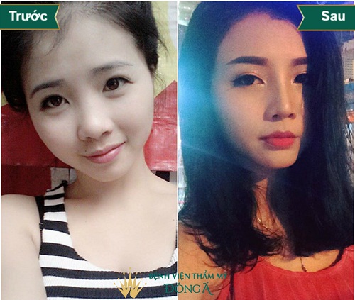 Topics tagged under 1 on Diễn đàn Tuổi trẻ Việt Nam | 2TVN Forum 5d0da3708a90680469000ad3_nang-mui-boc-sun-vanh-tai-2