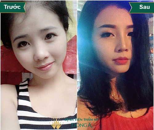 Topics tagged under 1 on Diễn đàn Tuổi trẻ Việt Nam | 2TVN Forum 5d0da3708a90680469000ad3_nang-mui-boc-sun-vanh-tai-2