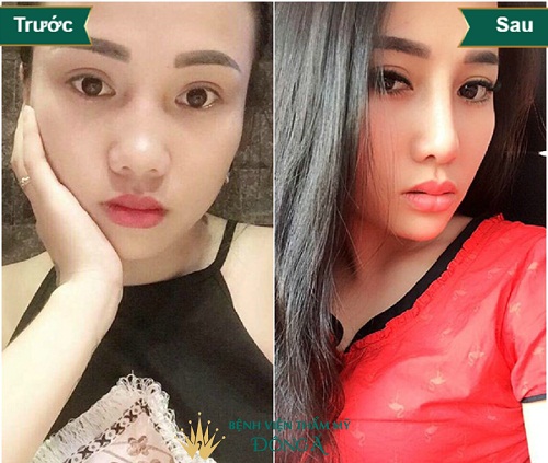 Nâng mũi để được bao lâu ? Bật mí bí kíp Nâng Mũi Đẹp Vĩnh viễn 5d0da3708a906874b8000ad2_nang-mui-boc-sun-vanh-tai-4